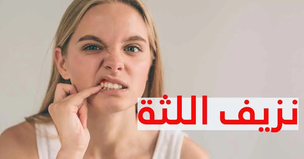 نزيف اللثة
